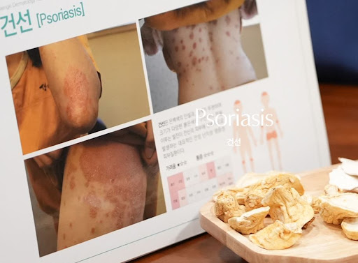 생기한의원 건선 관련, 무릎 부위 피부 변화 관찰 방법
